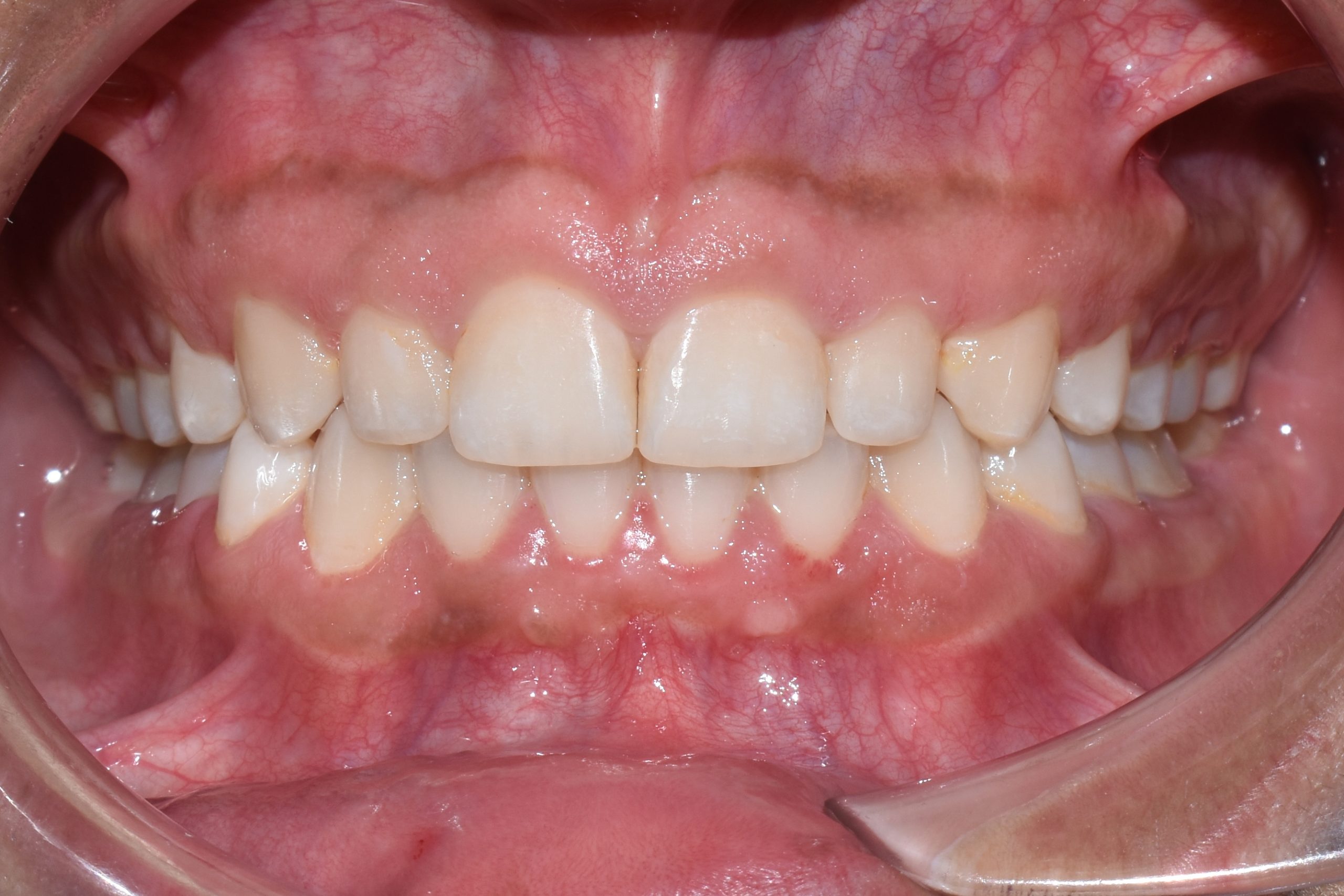Frontal (1)