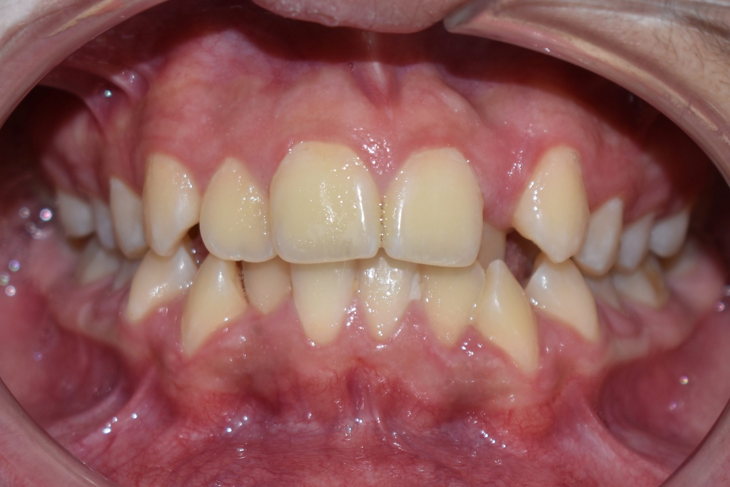 Frontal (2)