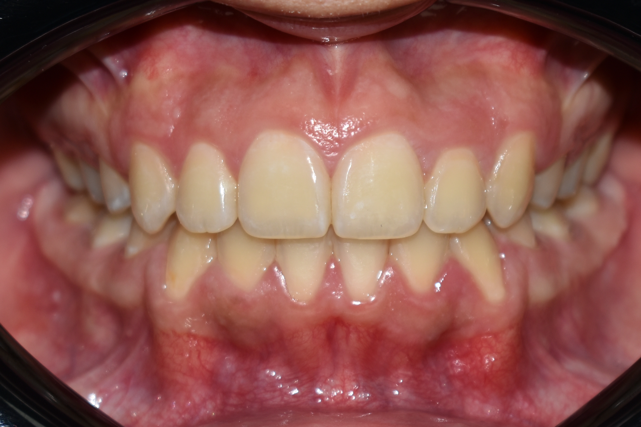 Frontal (3)