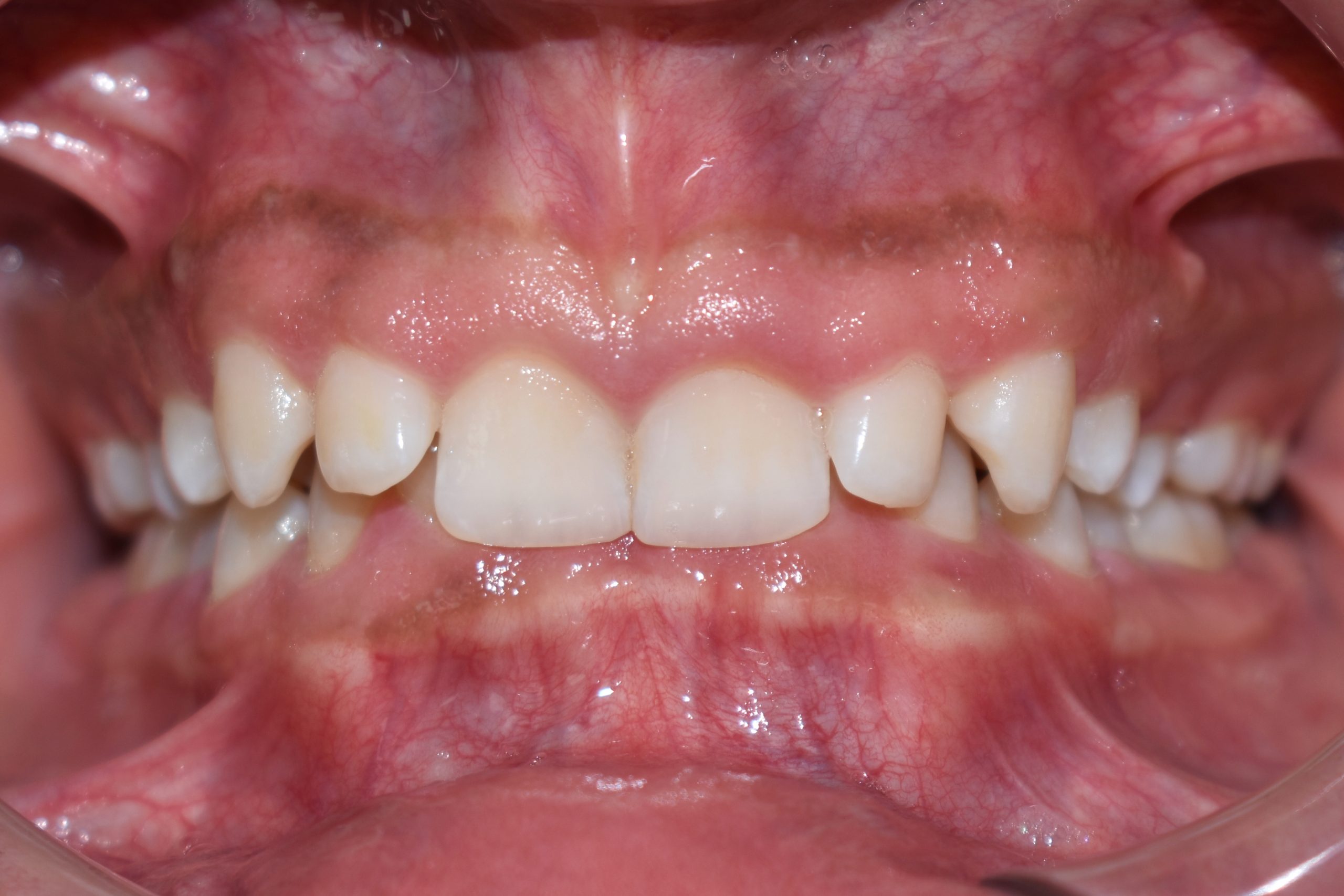 Frontal