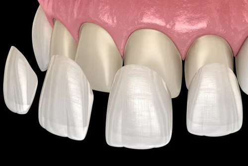 Carillas dentales